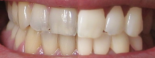 White Strips – An Epilogue