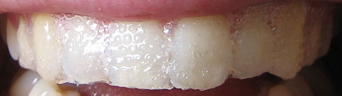 The White Strips Experiment Begins